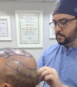 Paciente em consulta médica preparando-se para transplante capilar