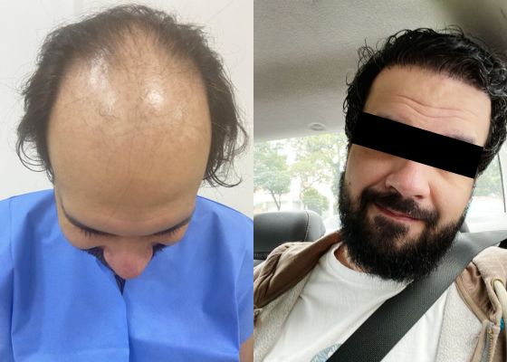 Antes e depois de procedimento realizado por cirurgião plástico especialista em transplante capilar