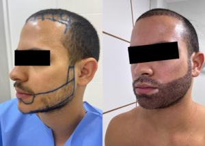 Implante capilar com técnica FUE mostrando aspecto natural na fase inicial de crescimento