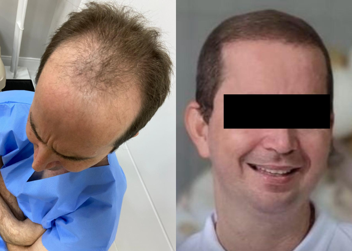 Resultado de transplante capilar FUE com restauração da linha frontal