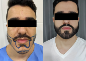 Antes e depois de transplante de barba realizado na Clínica Dr. Gustavo Mello, evidenciando o desenho técnico e o resultado natural.