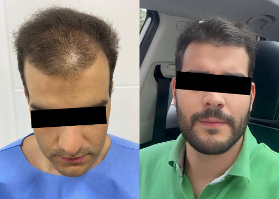 Paciente após transplante capilar com autoestima restaurada